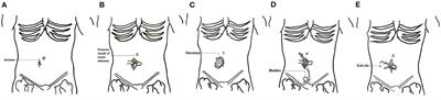 Risk Factors and Management of Catheter Malfunction During Urgent-Start Peritoneal Dialysis